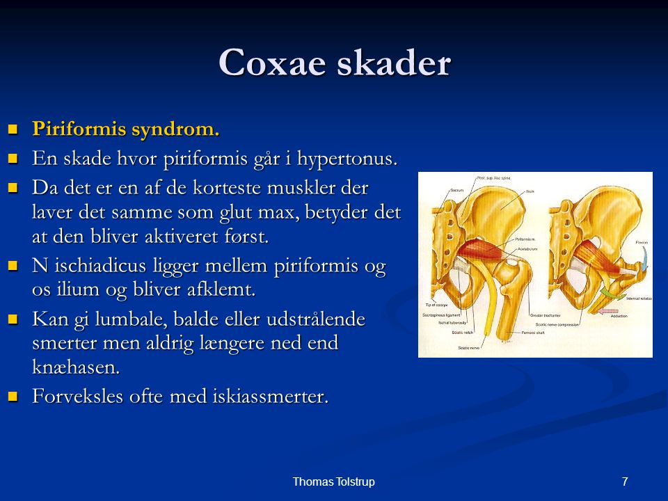Coxae skader Piriformis syndrom.