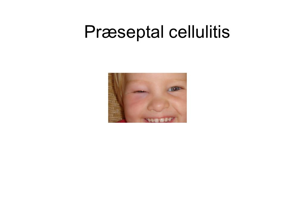 Præseptal cellulitis