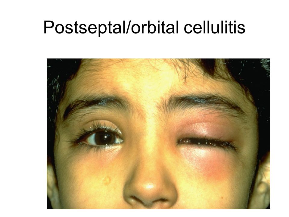 Postseptal/orbital cellulitis