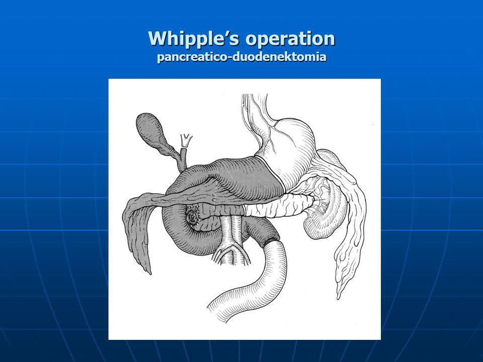 Whipple’s operation pancreatico-duodenektomia