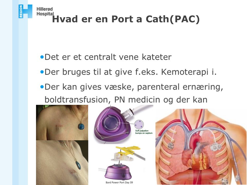 Hvad er en Port a Cath(PAC)