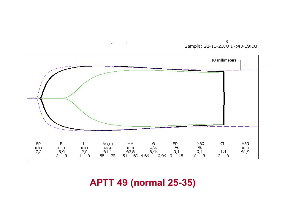 APTT 49 (normal 25-35)