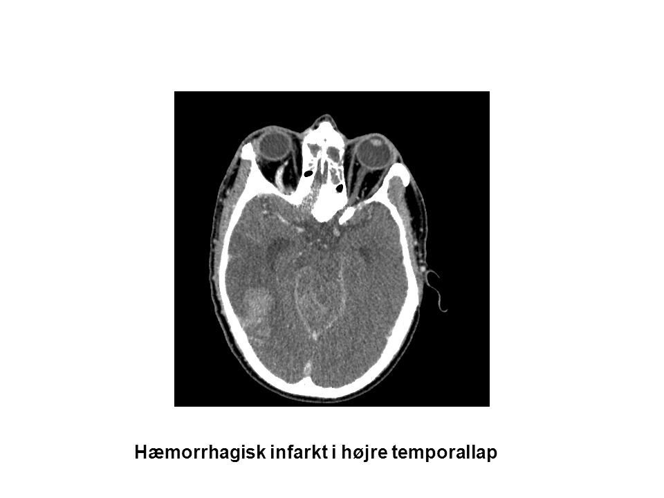 Hæmorrhagisk infarkt i højre temporallap