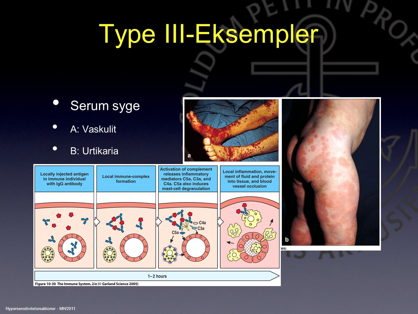 Type III-Eksempler Serum syge A: Vaskulit B: Urtikaria