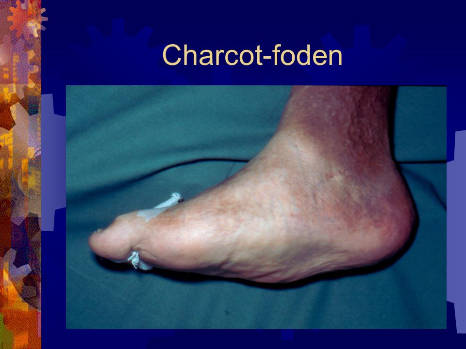 Charcot-foden