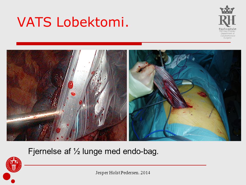 VATS Lobektomi. Fjernelse af ½ lunge med endo-bag.