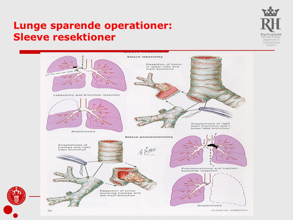Lunge sparende operationer: