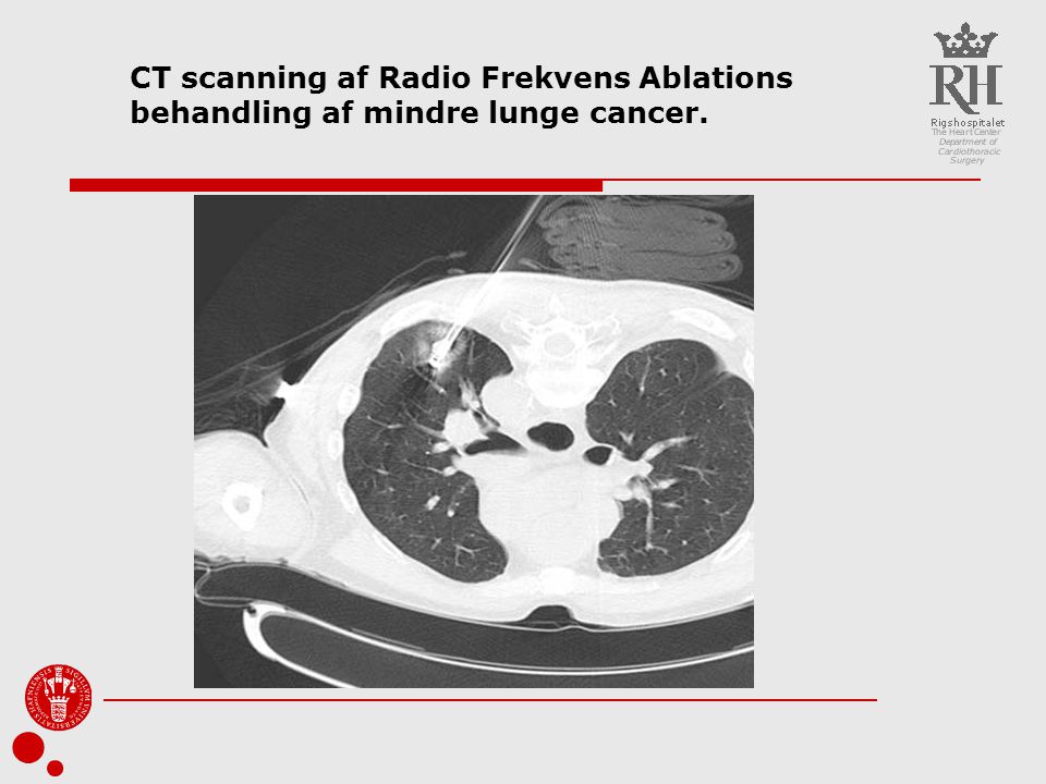 CT scanning af Radio Frekvens Ablations behandling af mindre lunge cancer.