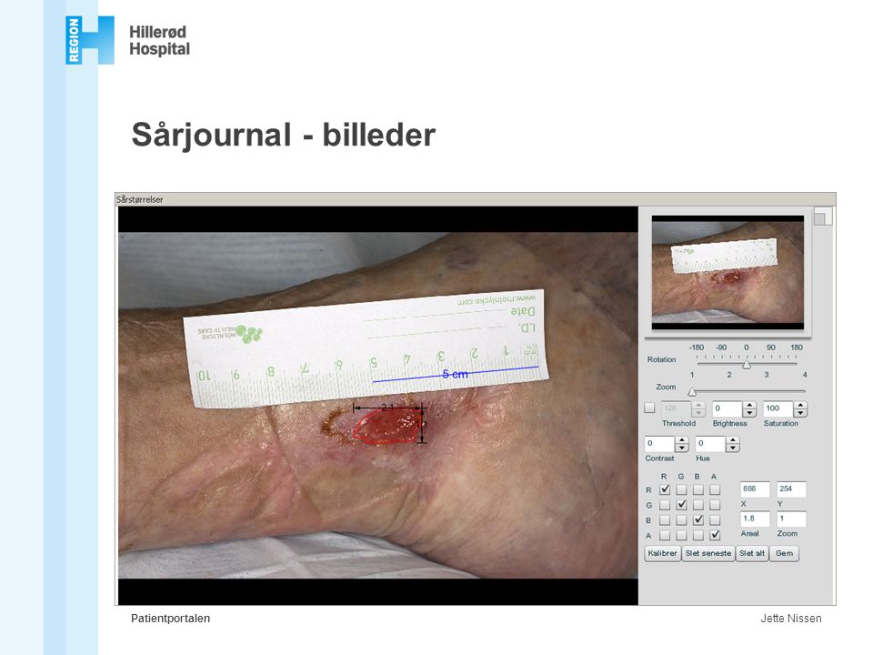 Sårjournal - billeder Patientportalen Jette Nissen
