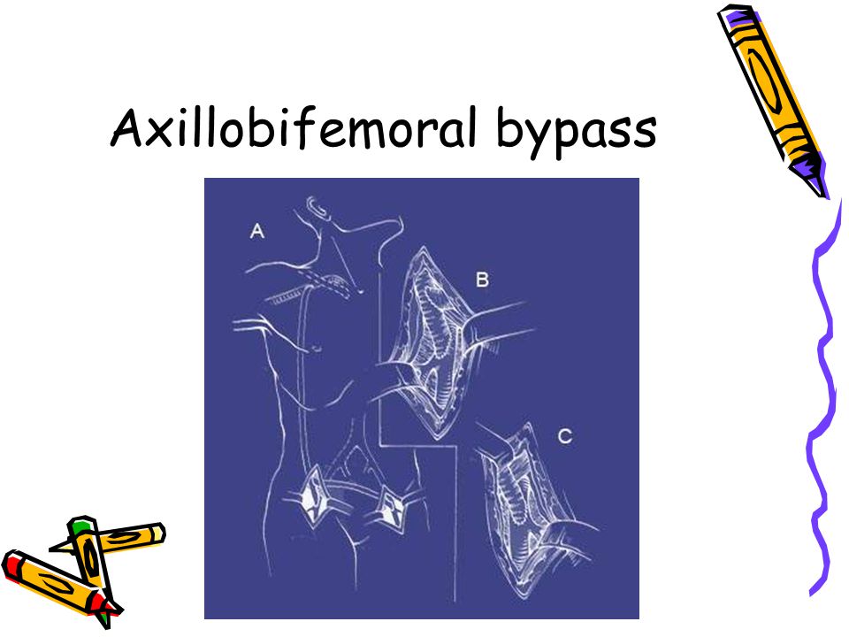 Axillobifemoral bypass