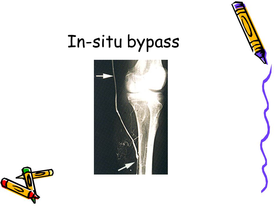 In-situ bypass