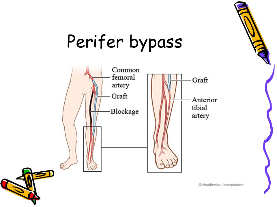 Perifer bypass