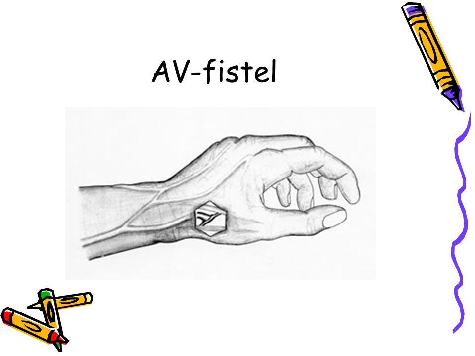 AV-fistel