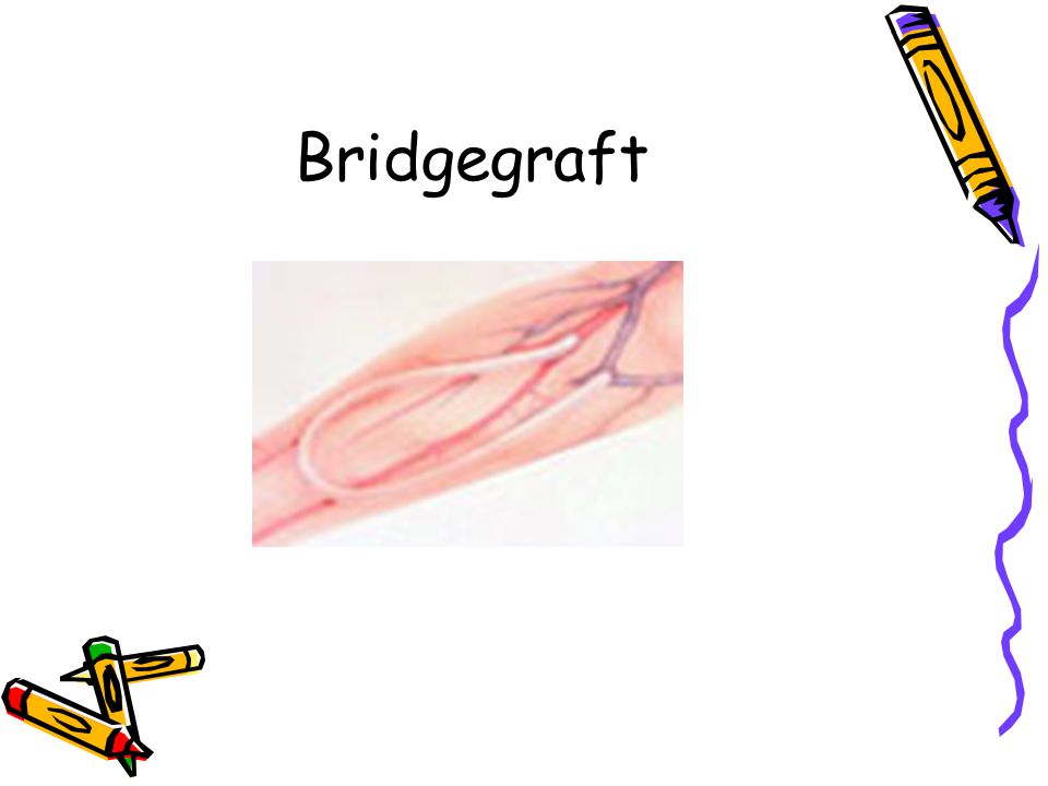 Bridgegraft