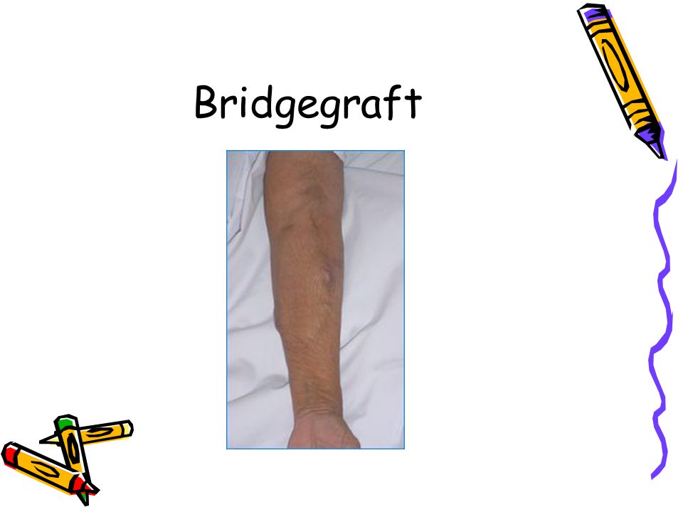 Bridgegraft