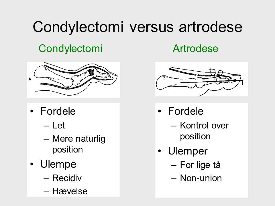 Condylectomi versus artrodese