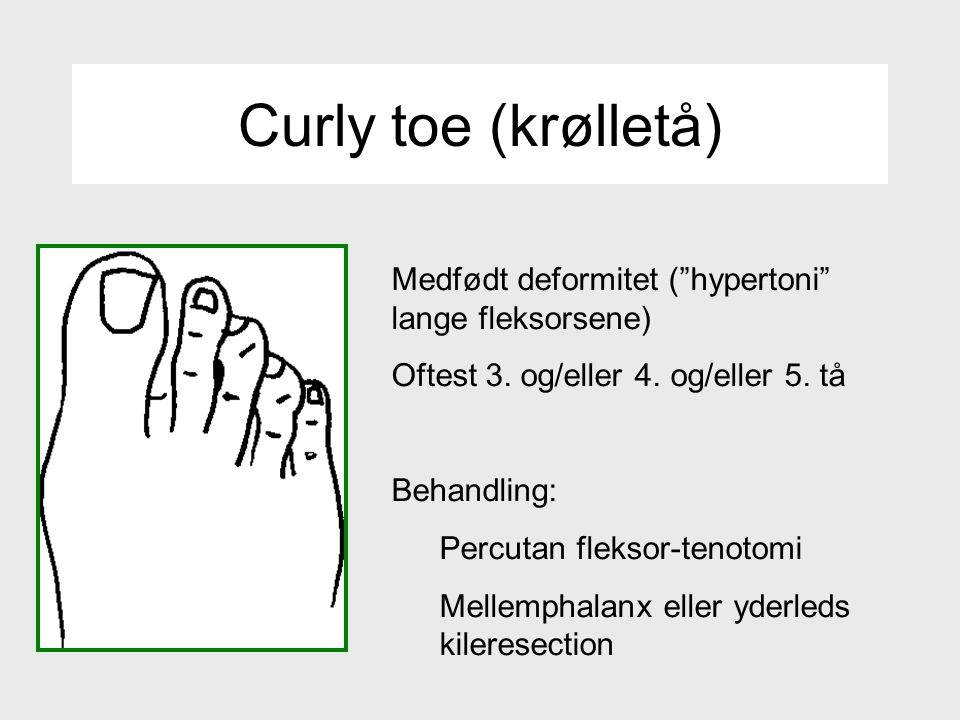 Curly toe (krølletå) Medfødt deformitet ( hypertoni lange fleksorsene) Oftest 3. og/eller 4. og/eller 5. tå.