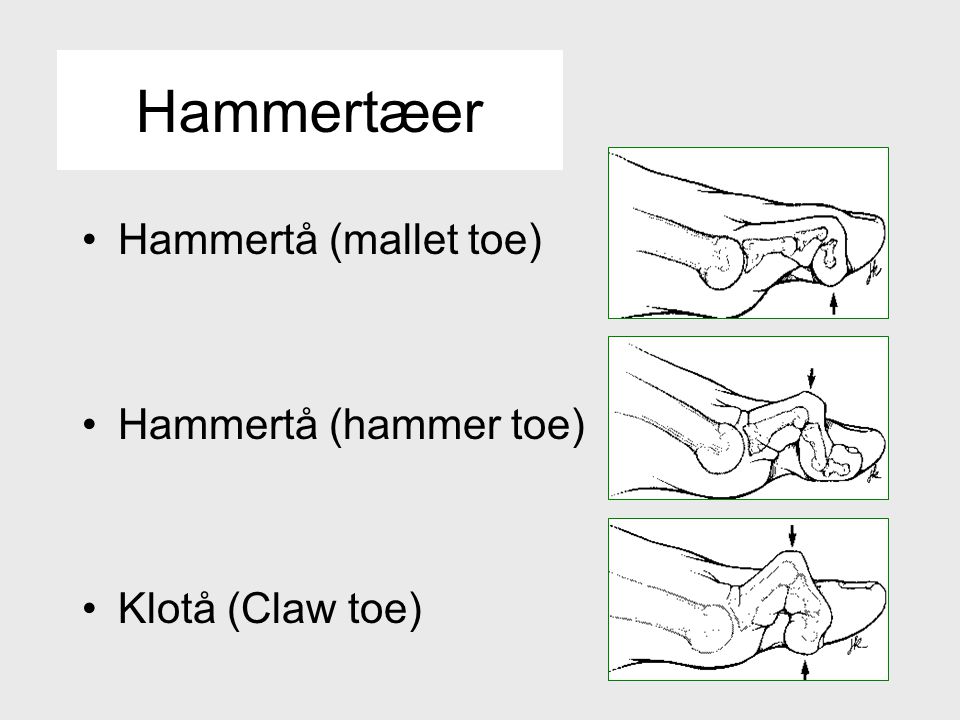 Hammertæer Hammertå (mallet toe) Hammertå (hammer toe)