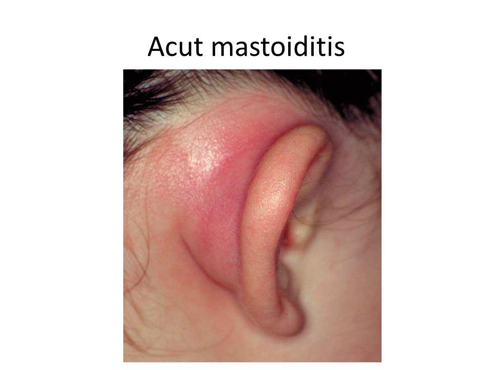 Acut mastoiditis