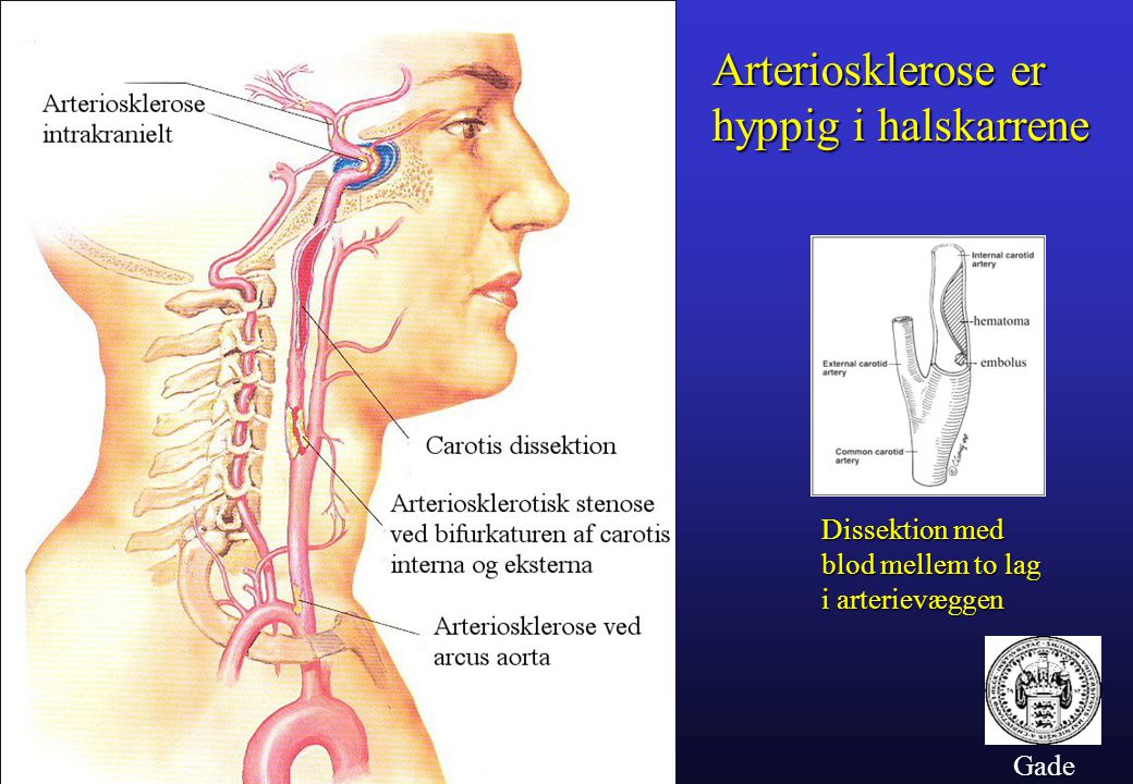 Arteriosklerose er hyppig i halskarrene