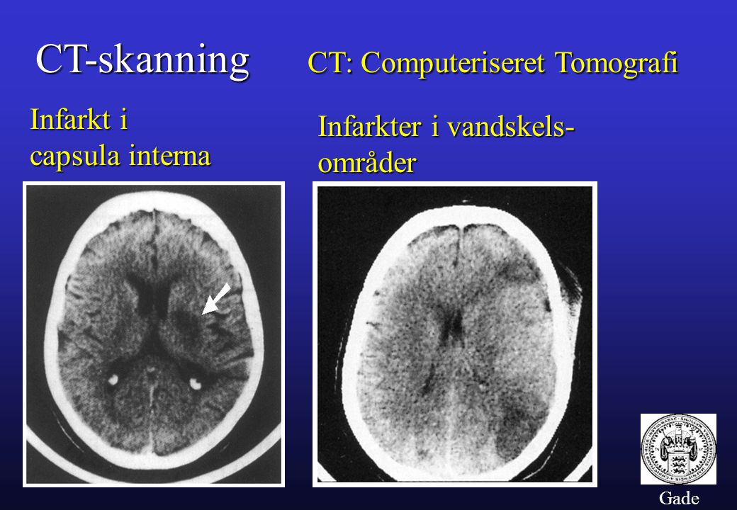 CT-skanning CT: Computeriseret Tomografi