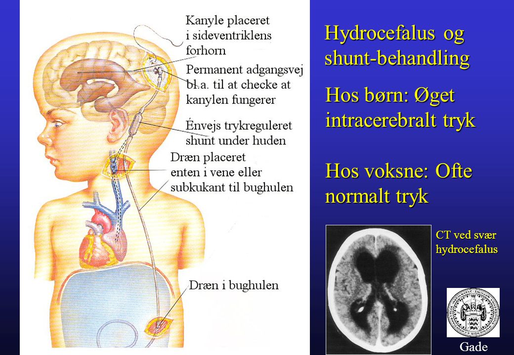Hydrocefalus og shunt-behandling